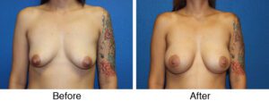 A woman with tattoos and no bra is shown before and after breast augmentation.