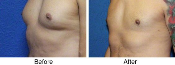 A before and after photo of a man 's chest.