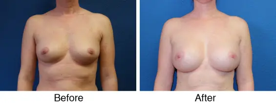 A before and after photo of a woman with breast implants.