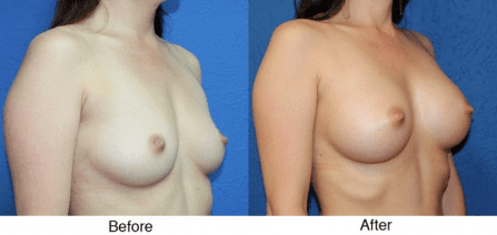 A before and after picture of breast augmentation surgery.