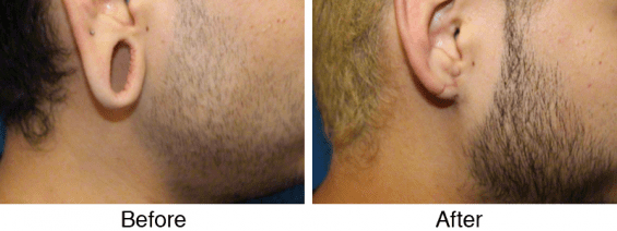A before and after photo of the hair transplant.