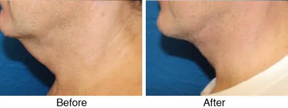 A before and after photo of the neck area.