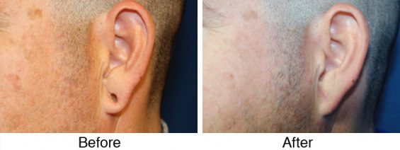 A man 's ear and the side of his face.