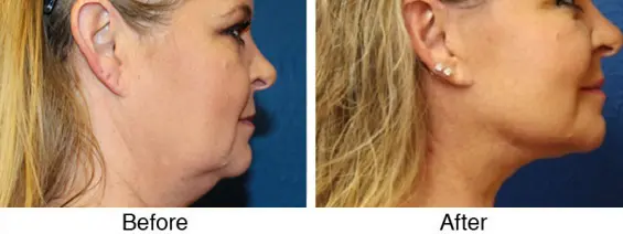A woman with an undergone facelift and chin implant.