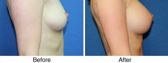 A before and after photo of the breast implant.