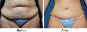 A before and after photo of an abdominoplasty procedure.