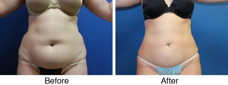 A before and after photo of a woman 's stomach.