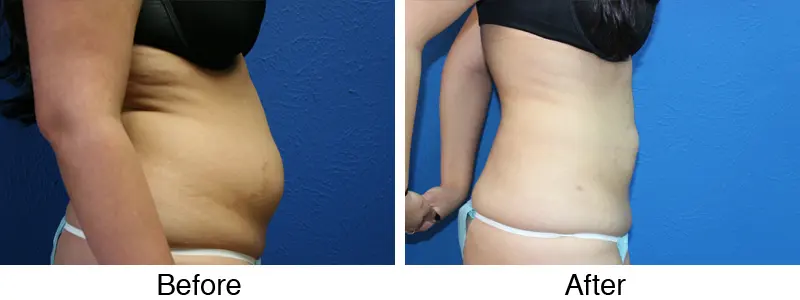 A woman is shown before and after her liposuction procedure.
