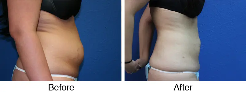 A woman is shown before and after her liposuction procedure.