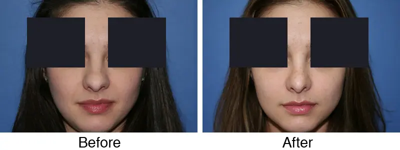 A before and after picture of the same patient.