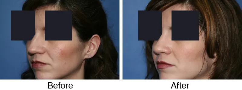 A woman with long hair and dark eyes is shown before and after surgery.