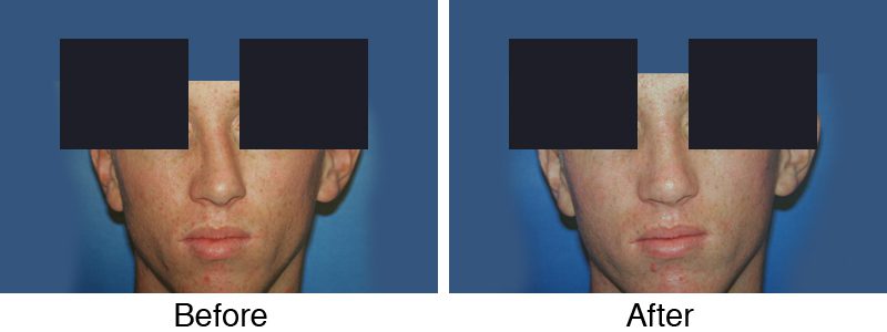 A before and after photo of the same patient 's face.