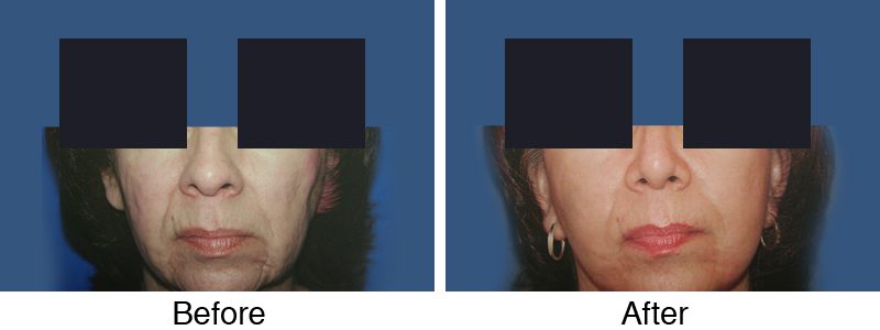 A before and after picture of the same patient 's face.
