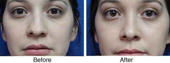 A before and after picture of the same woman 's eyes.