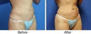 Abdomen slimmed after liposuction
