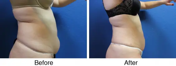 A before and after picture of the same woman 's body.