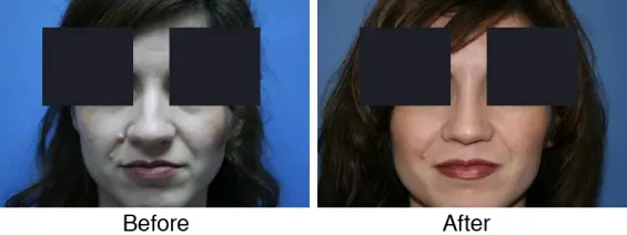 A before and after picture of a woman with rhinoplasty.