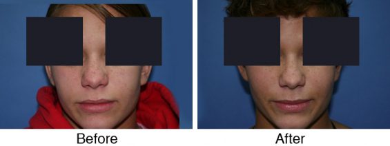 A man with dark hair and blue eyes is shown before and after his rhinoplasty.