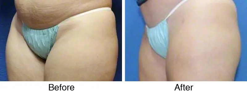 A woman 's buttocks and legs before and after surgery.