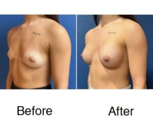 Before and after breast augmentation comparison