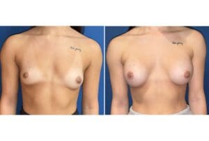 Frontal before-and-after breast augmentation photos