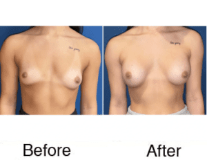 Before and after breast augmentation