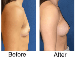 Breast augmentation before and after side view