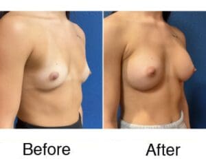 Breast augmentation before-and-after results