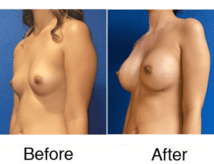 Side-by-side breast augmentation before and after