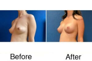 Before-and-after breast augmentation result