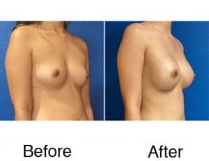 Before and after breast augmentation