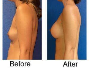 Breast augmentation before and after profile