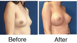 Breast augmentation before and after comparison
