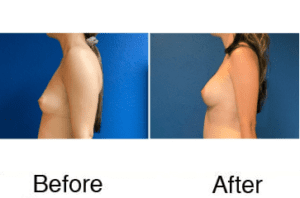 Before and after breast augmentation side profiles