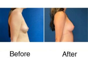 Breast augmentation before and after side view