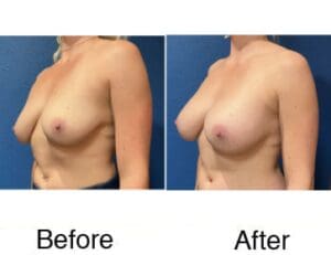 Before and after breast augmentation results