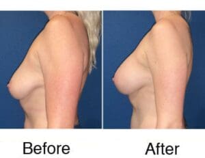 Before and after breast augmentation side view