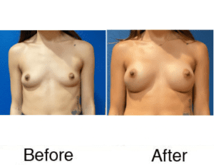 Before and after breast augmentation