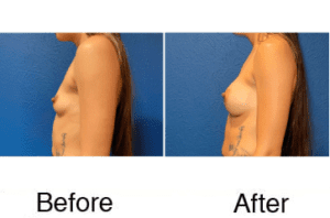 Before and after breast augmentation side view