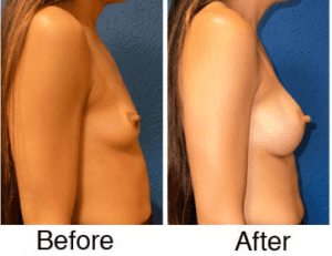 Before and after breast augmentation side view