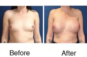 Breast augmentation before and after photo