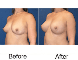 Before and after breast augmentation comparison