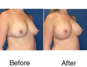 Breast augmentation before and after comparison