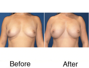 Before and after breast augmentation