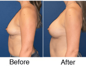 Side-by-side before and after breast augmentation