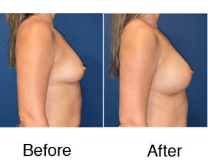 Before and after breast augmentation side view