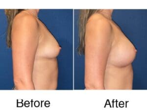 Before and after breast augmentation side view