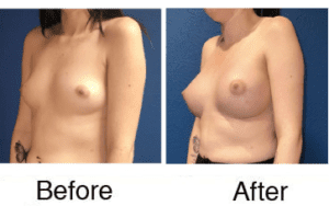 Before and after breast augmentation photos