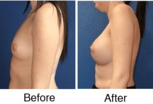 Before and after breast augmentation side profile